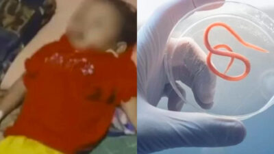 Menkes Sebut Penyebab Kematian Balita Sukabumi bukan Cacing, Dokter Ungkap Kisah Pilu Saat Membantu Sang Bocah
